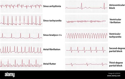 abnormal ekg examples.